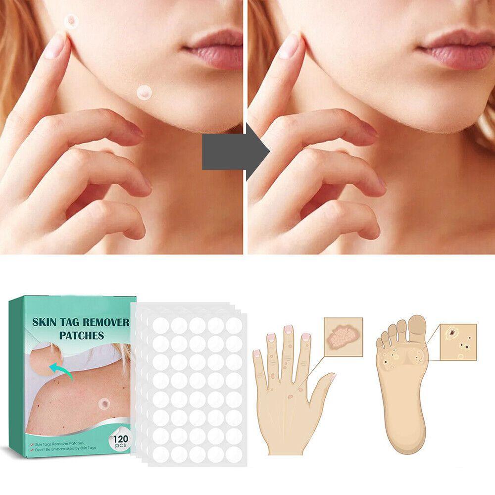 Skin Tag Patches
